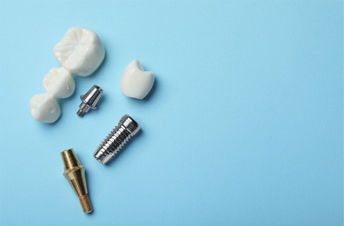 Illustration of four dental implants and denture