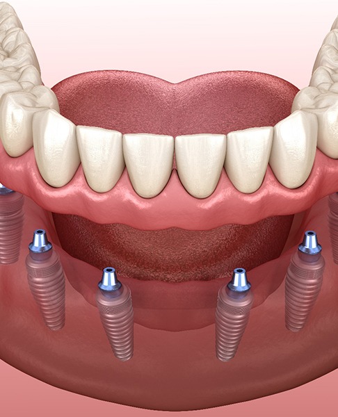 Illustration of implant denture supported by six implants