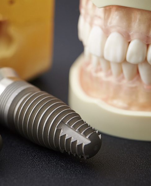 Close-up of dental implants next to dental model