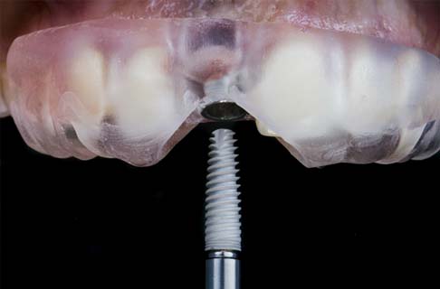 Guided Dental Implant Surgery in Dallas 