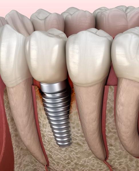 Illustration of infection around dental implant