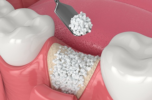 Performing bone grafting for dental implants in Dallas TX