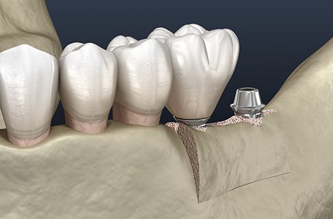  Illustration of dental implants in Dallas TX in jaw after ridge expansion