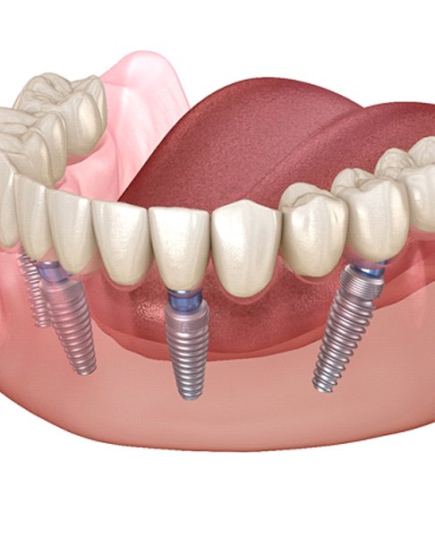 Illustration of All-on-4 implant denture for lower arch