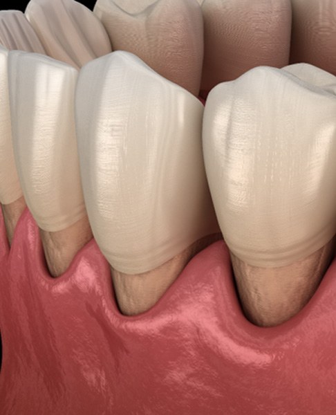 Illustration of receding gums on several teeth in lower arch