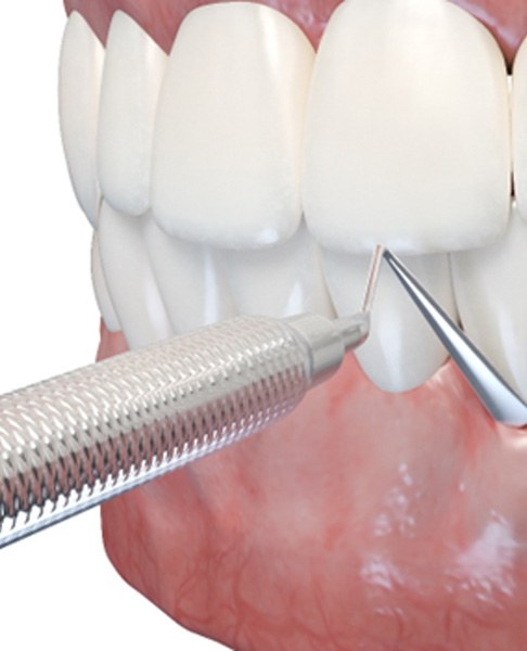 Illustration showing tissue being grafted onto gums