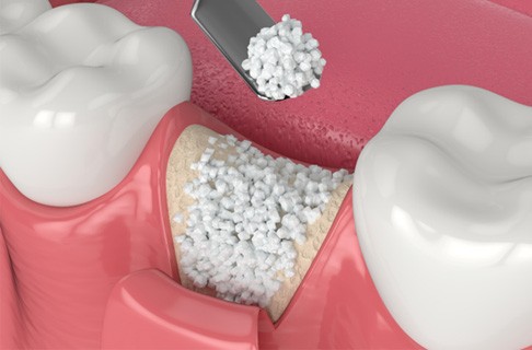 Dentist pointing to parts of dental implant in Dallas