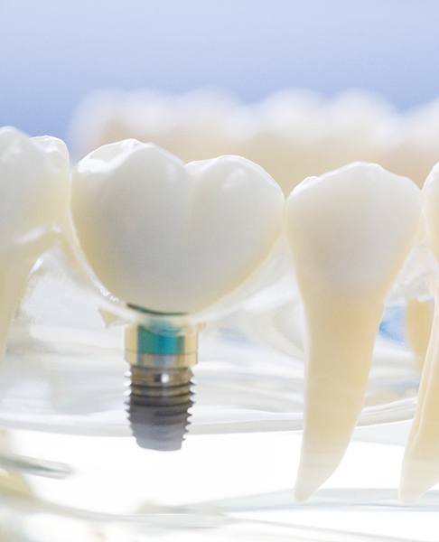 Model jaw with dental implants in Dallas