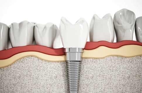 Illustration of dental implant integrated with surrounding bone