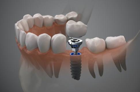 Animated dental implant supported dental crown placement