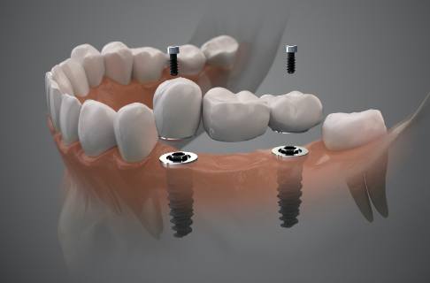 Animated dental implant supported fixed bridge placement