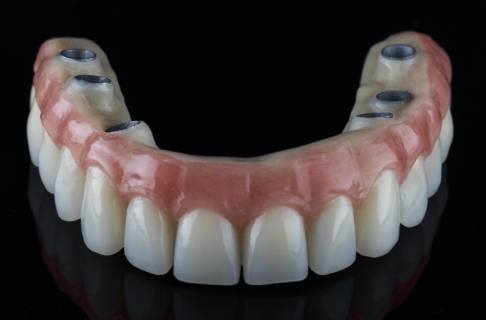 Dental implant retained denture prior to placement