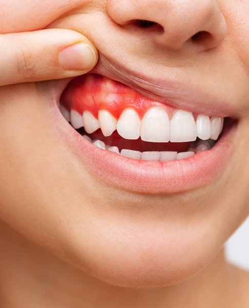 Woman with red, swollen gums in Dallas