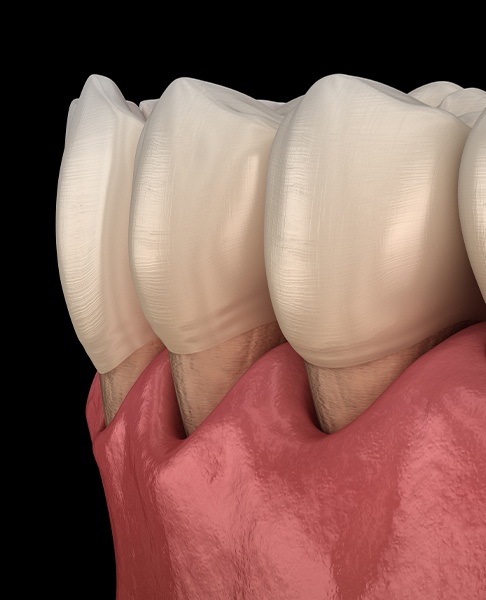 Animated smile with recessed gum tissue due to periodontal disease