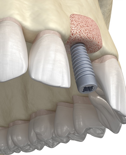 Animated smile with dental implant post placed into bone graft