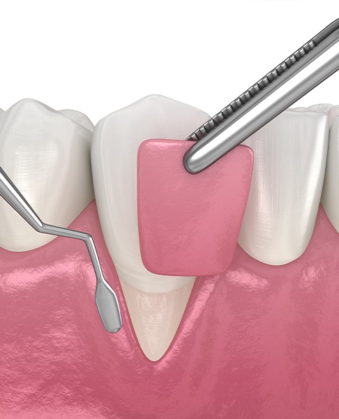 Animated smile during gum grafting process
