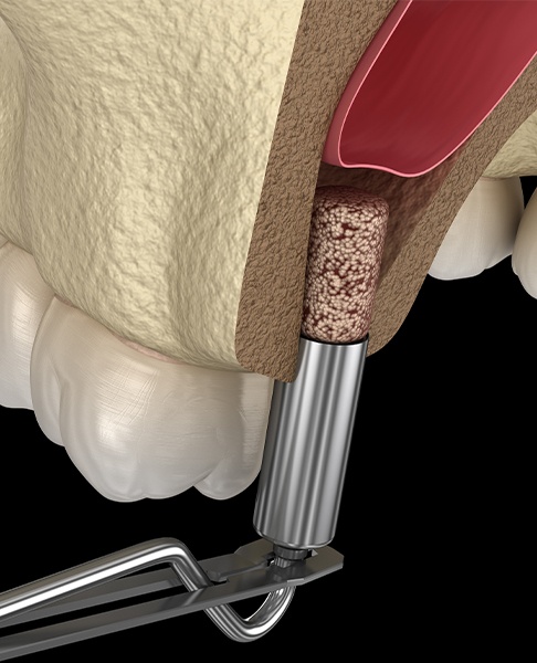 Aniamted sinus lift bone grafting process