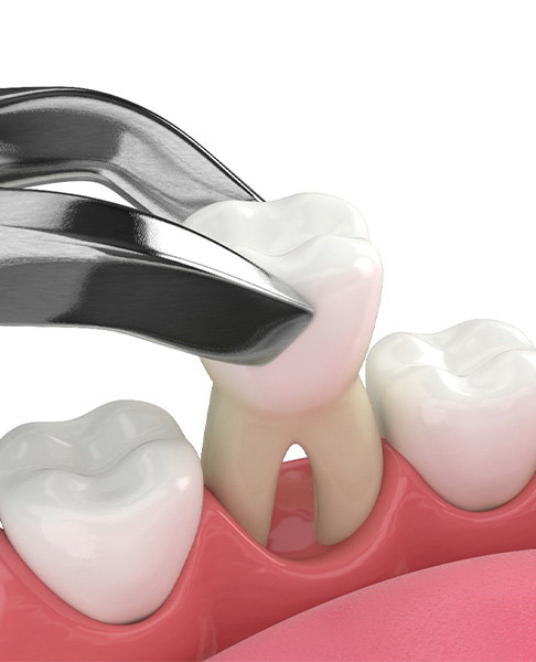 Illustration of tooth being removed with forceps