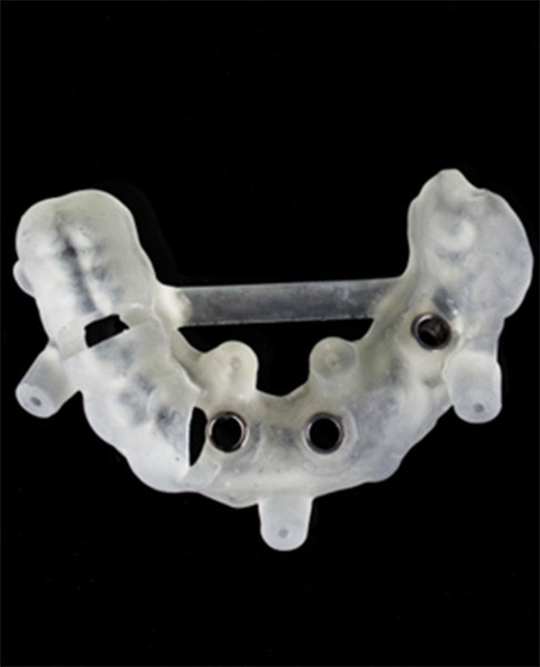 Pair of 3D-printed dental implant guides