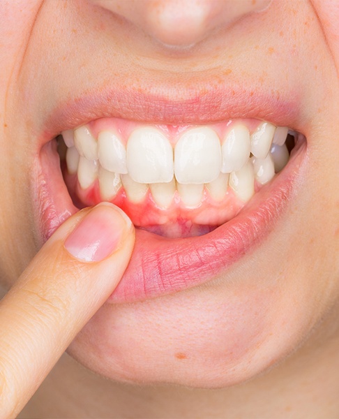 Patient pointing to inflamed gum tissue