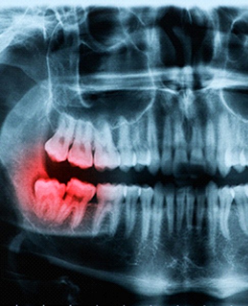 X-ray of wisdom teeth from a periodontist in Dallas