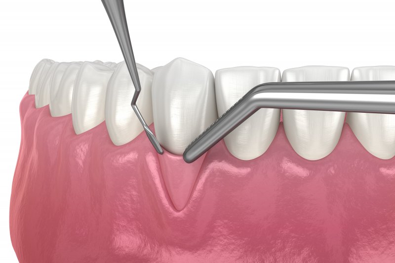 Computer illustration of a gum grafting procedure