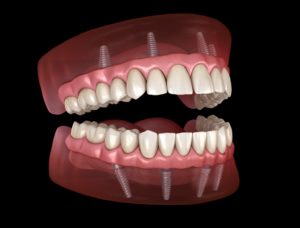 Digital model of implant dentures