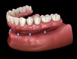 Digital model of lower All-On-4 implant