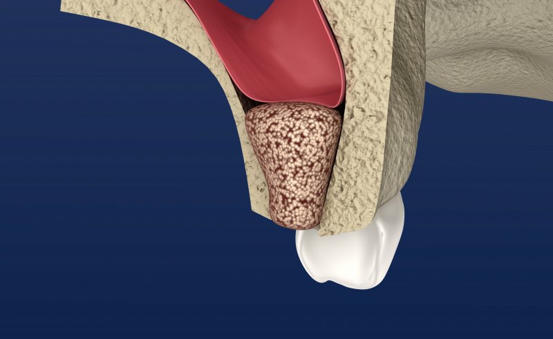 Illustration of sinus lift before dental implants are placed