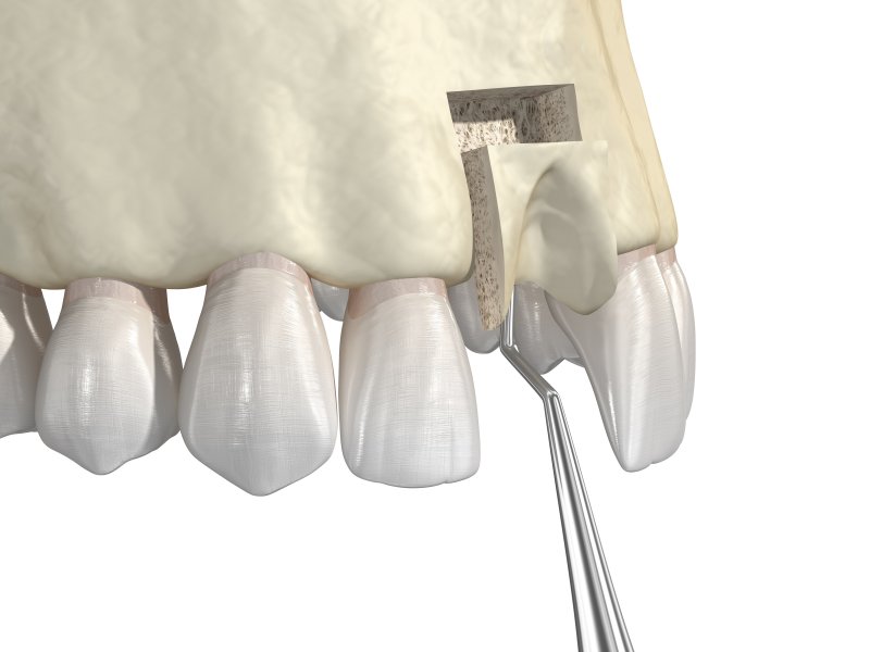 Illustration of bone grafting for the upper jaw