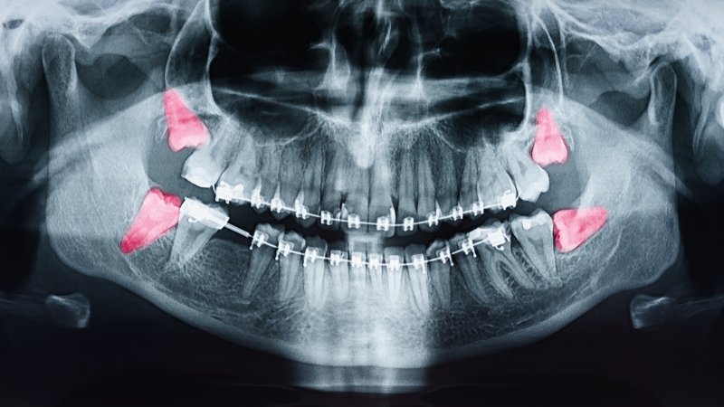 X-ray of a patient with all four wisdom teeth