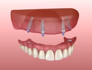 All-on-4 upper denture