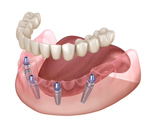 Illustration of All-on-4 for the lower arch